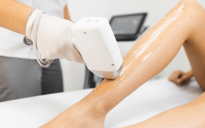 The Ultimate Guide to Laser Hair Removal at Wymore Laser and AntiAging Medicine in Winter Park, Florida