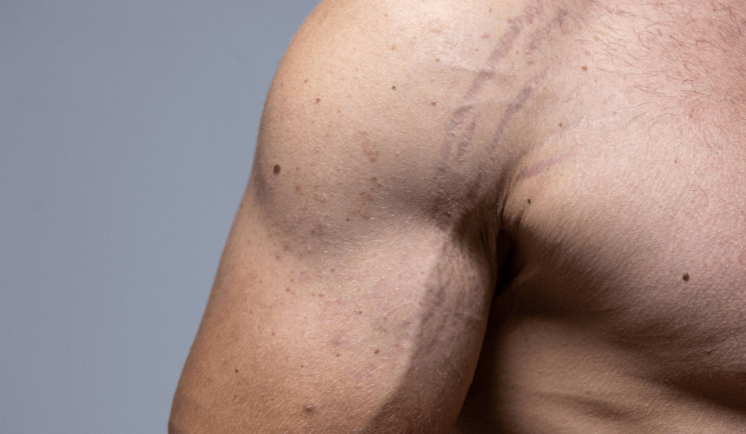 Where can I Get Laser Stretch Mark Removal?