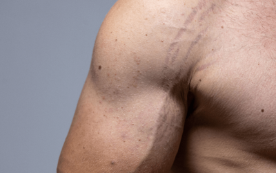 Where can I Get Laser Stretch Mark Removal?