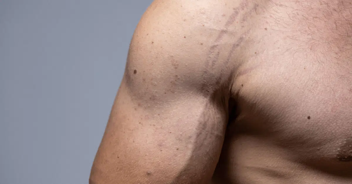 laser stretch mark removal