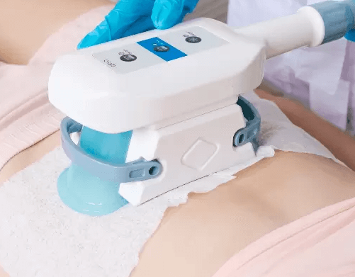Body Laser Treatment Orlando