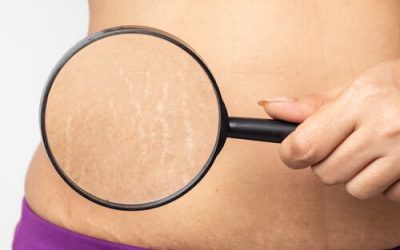 Say Goodbye to Stretch Marks: Orlando’s Top Stretch Mark Removal Treatments