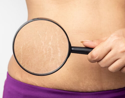 Say Goodbye to Stretch Marks: Orlando’s Top Stretch Mark Removal Treatments