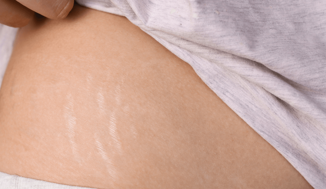 Erase the Lines: Exploring Stretch Mark Removal Solutions