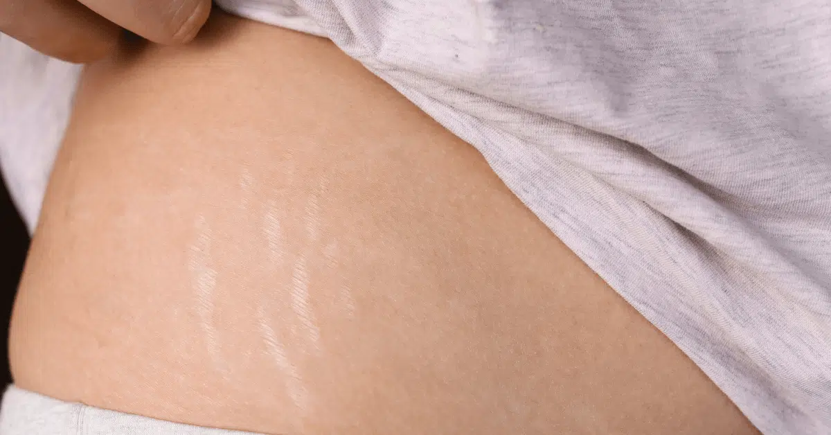 Stretch Mark Removal