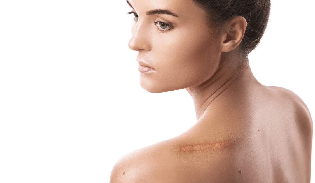 Erase Scars with Precision: Best Laser Treatment in Town