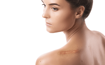 Erase Scars with Precision: Best Laser Treatment in Town