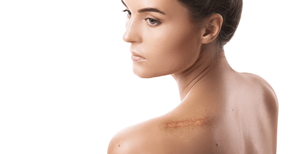 Laser scar treatment in town