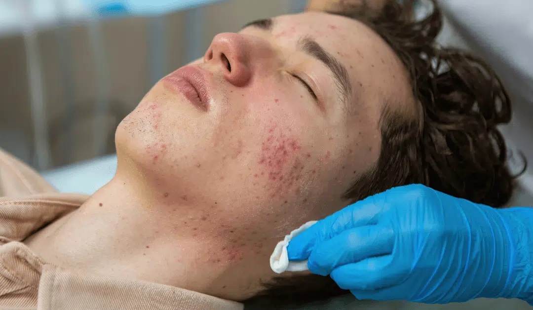 Radiant Recovery: Sun Damage and Redness Solutions at Our Laser Treatment Center