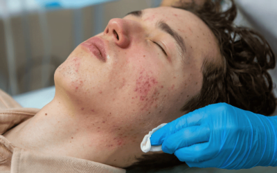 Radiant Recovery: Sun Damage and Redness Solutions at Our Laser Treatment Center