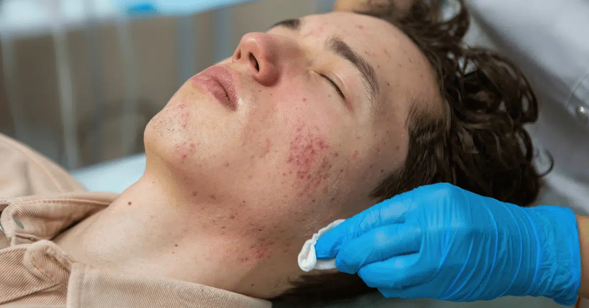 Sun Damage and Redness Laser Treatment Sun Damage and Redness Laser Treatment