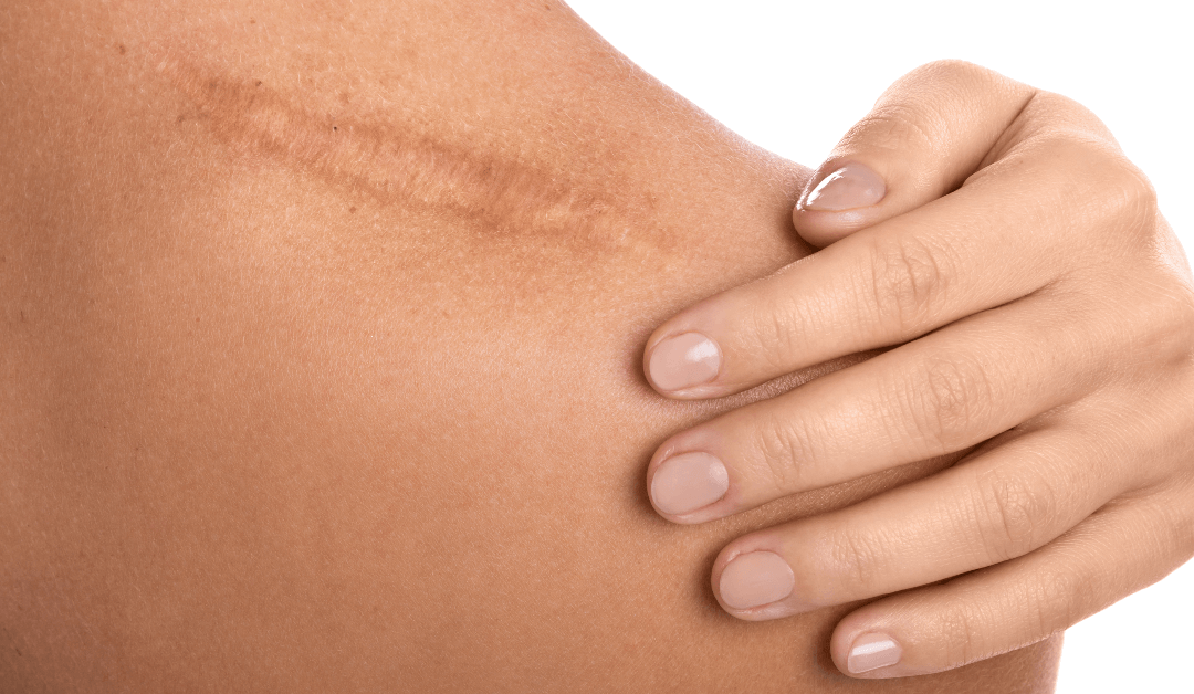 Unveiling Your Skin’s Potential: Laser Scar Treatment Explained