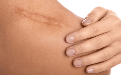 Unveiling Your Skin’s Potential: Laser Scar Treatment Explained