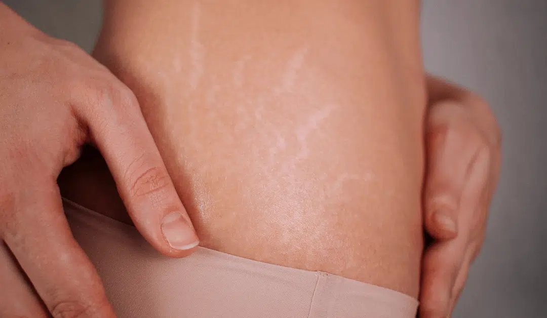 Vanishing Stretch Marks: Effective Strategies for Removal and Skin Rejuvenation