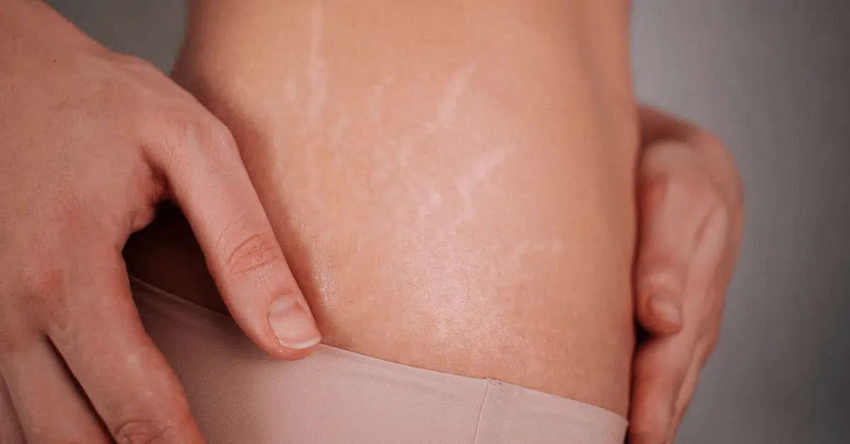 Stretch Mark Removal near me