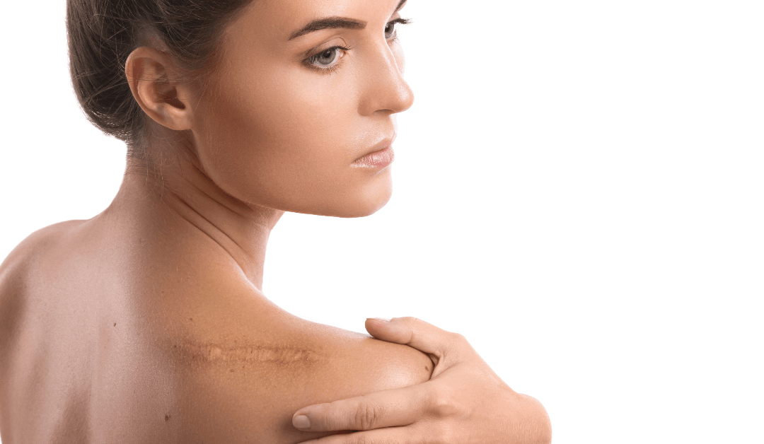 Erase Your Scars: Discover Laser Scar Removal Solutions