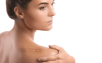 Erase Your Scars: Discover Laser Scar Removal Solutions