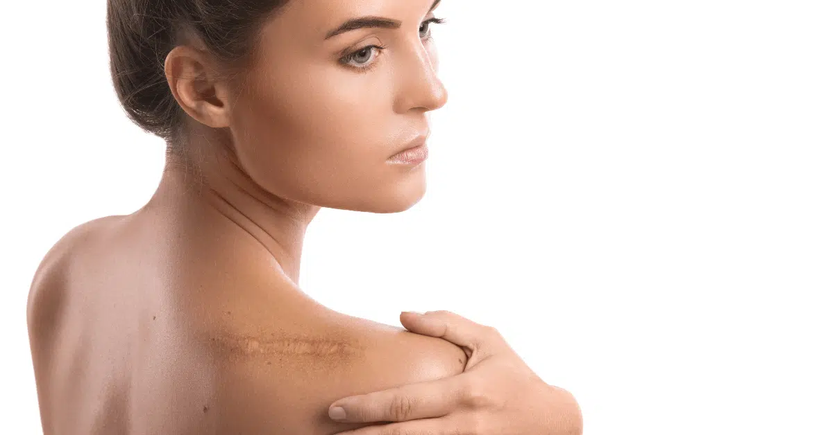 Laser Scar Removal