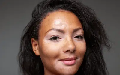 Combating Hyperpigmentation: IPL Treatment For Dark Spots