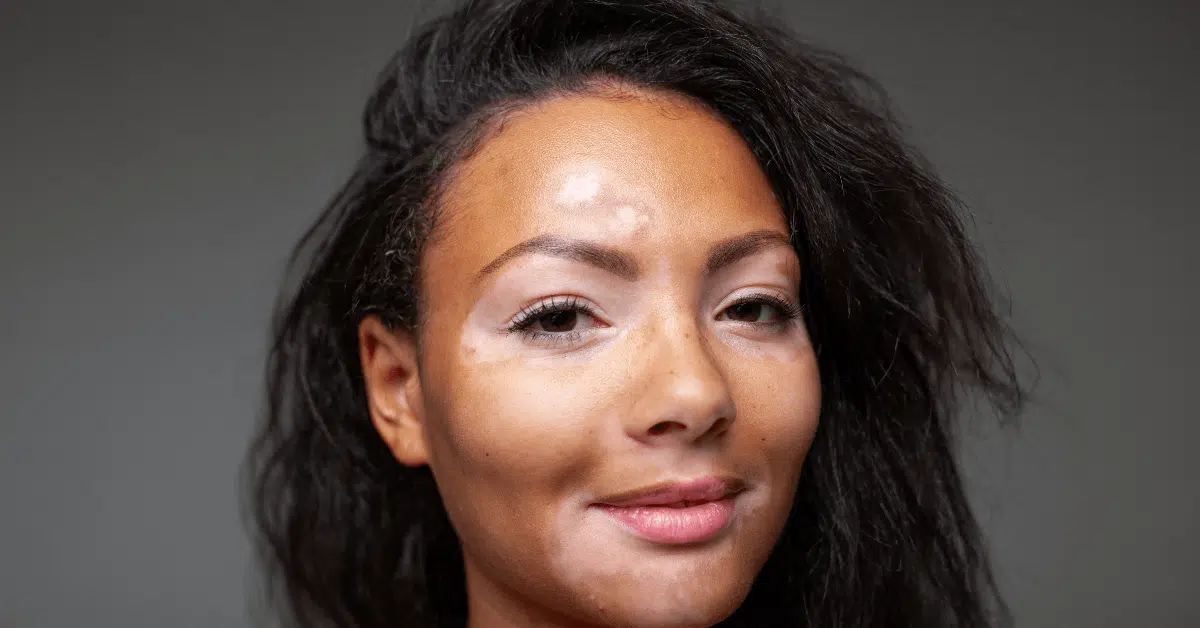 IPL Treatment for Dark Spots