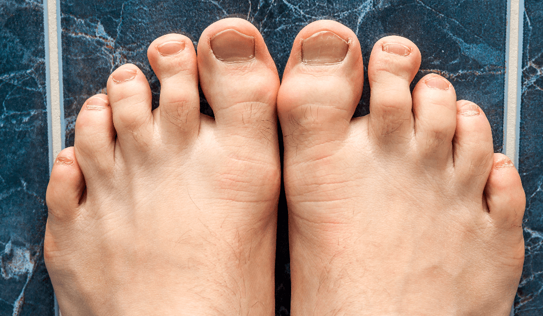 Laser Treatment For Onychomycosis At Wymore Laser: How It Works