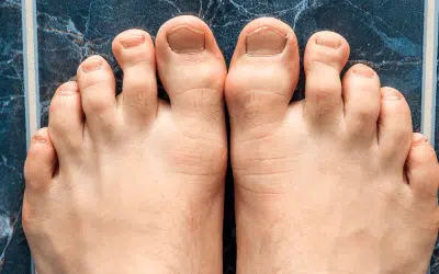 Laser Treatment For Onychomycosis At Wymore Laser: How It Works