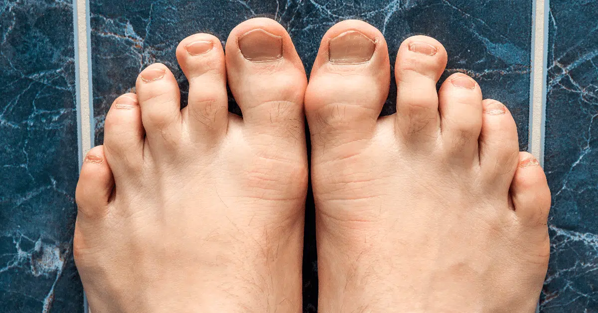 Onychomycosis Laser Treatment
