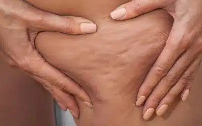 Achieve Your Beauty Goals with Diet Injections, Cellulite Reduction Laser, And More