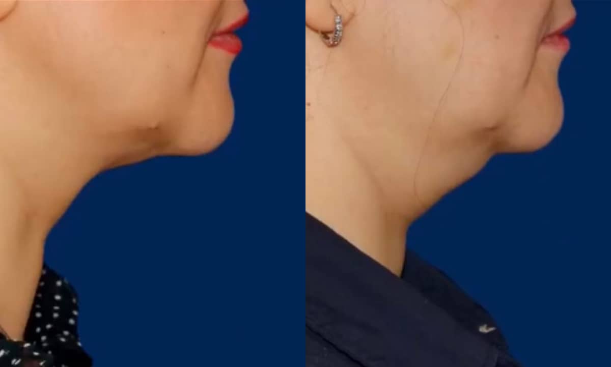 before-b