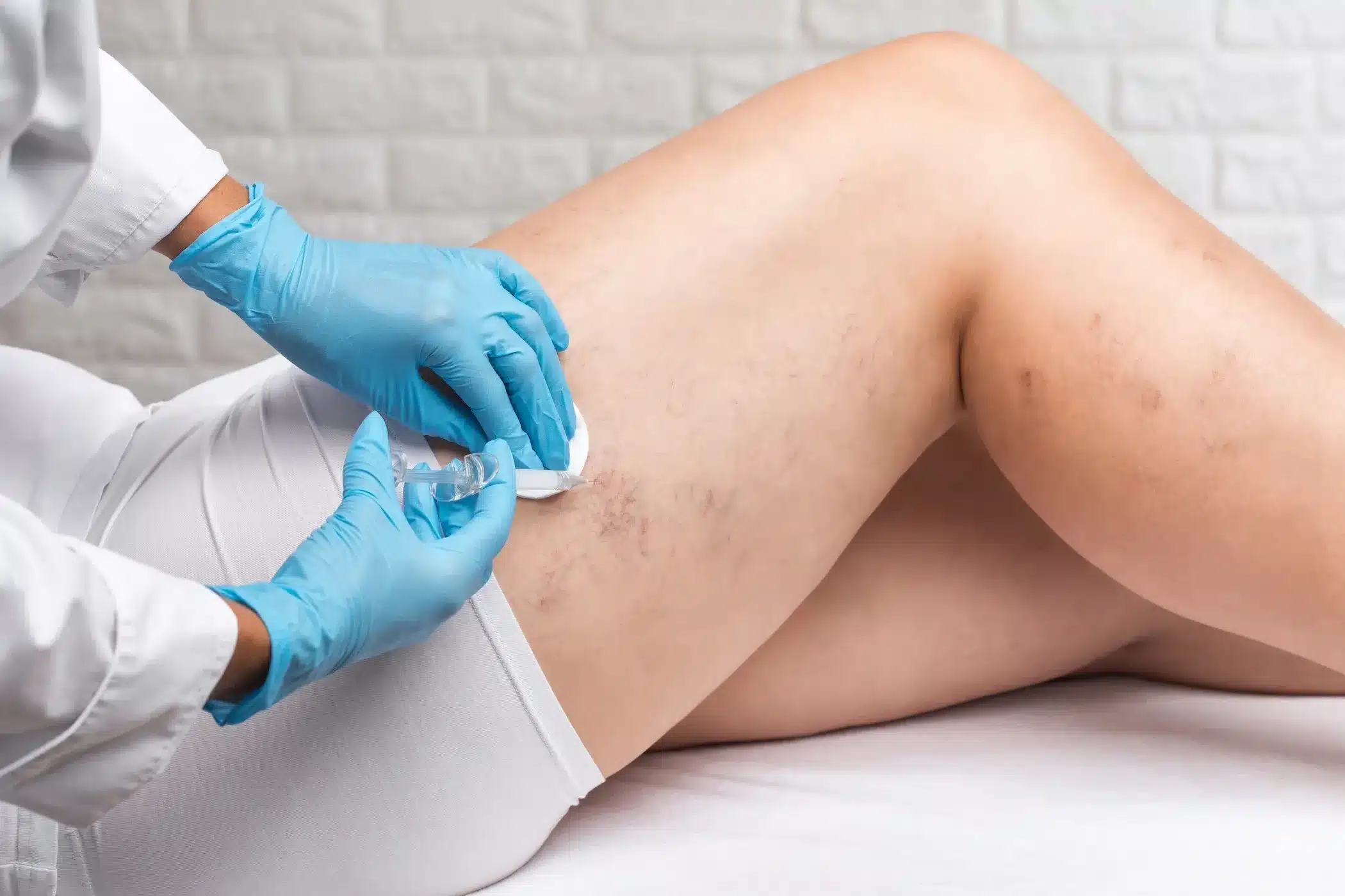 Vein Removal Orlando
