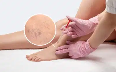 Vein Removal Orlando