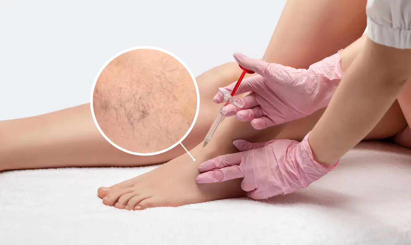 Vein Removal Orlando