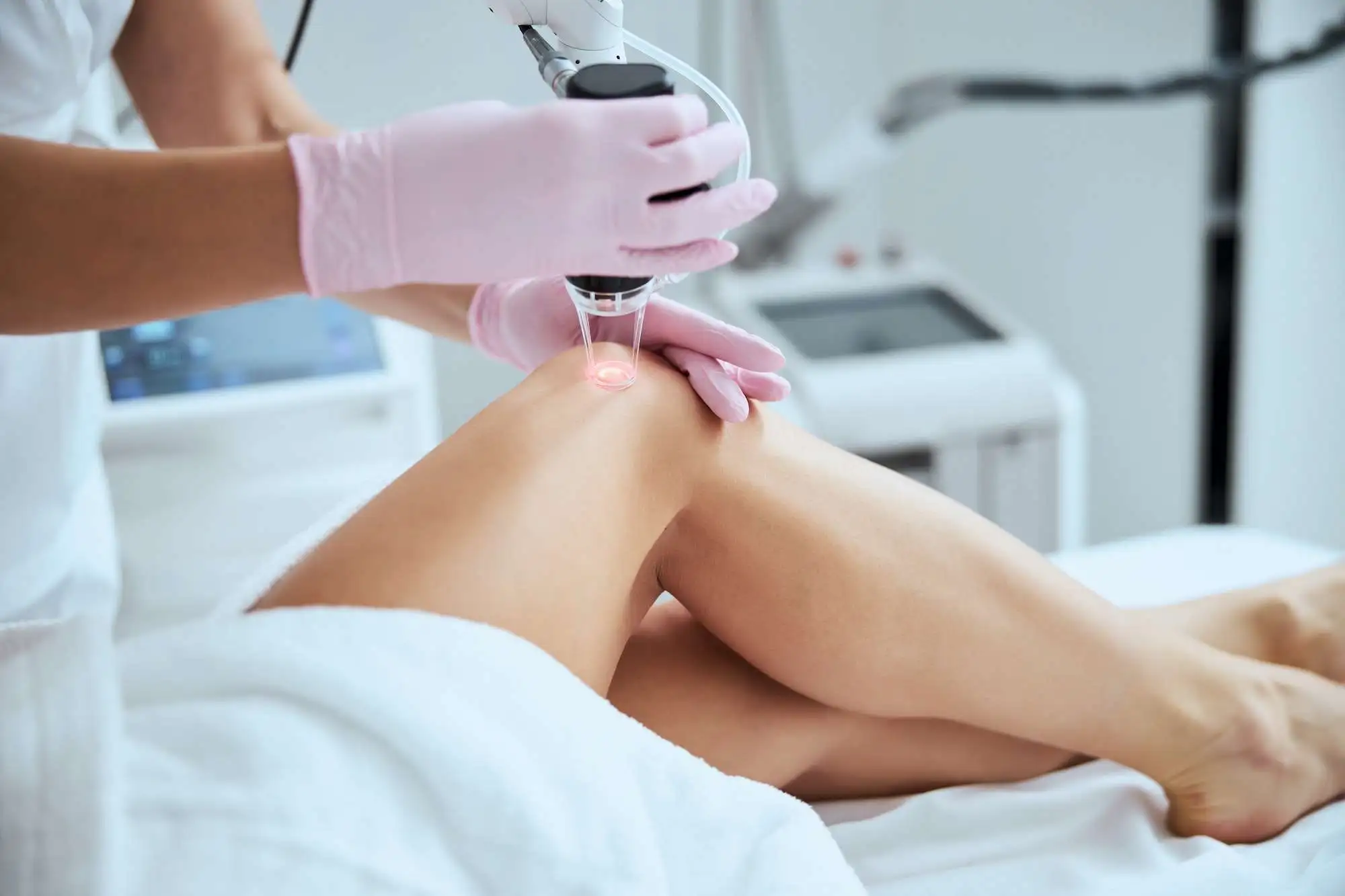 Vein Removal Orlando