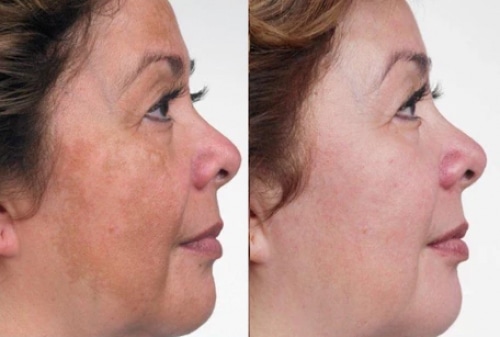 Chemical Peels Orlando