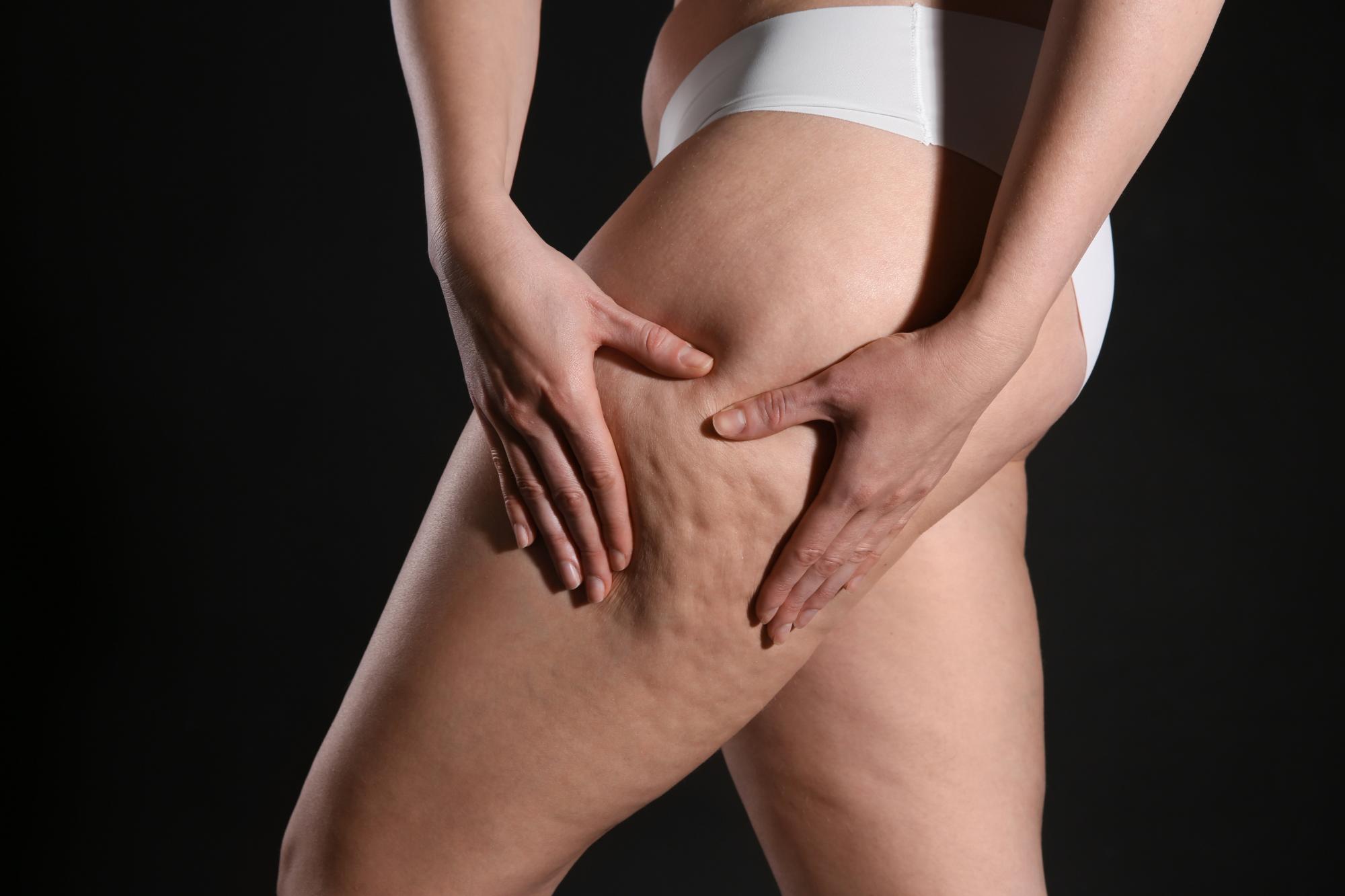 Laser Treatments For Cellulite