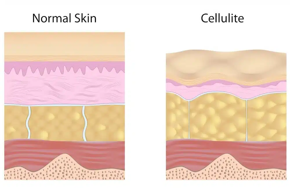 Laser Treatments For Cellulite
