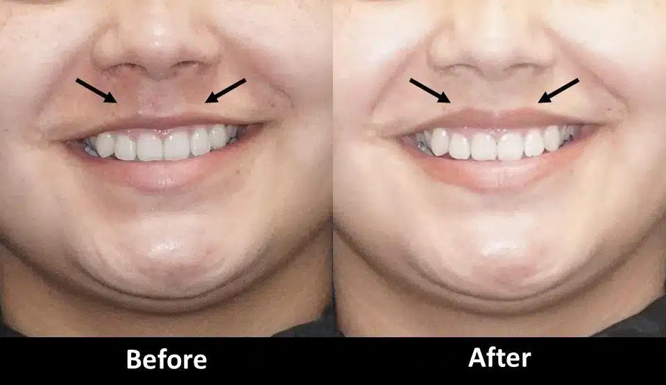 botox for mouth corners