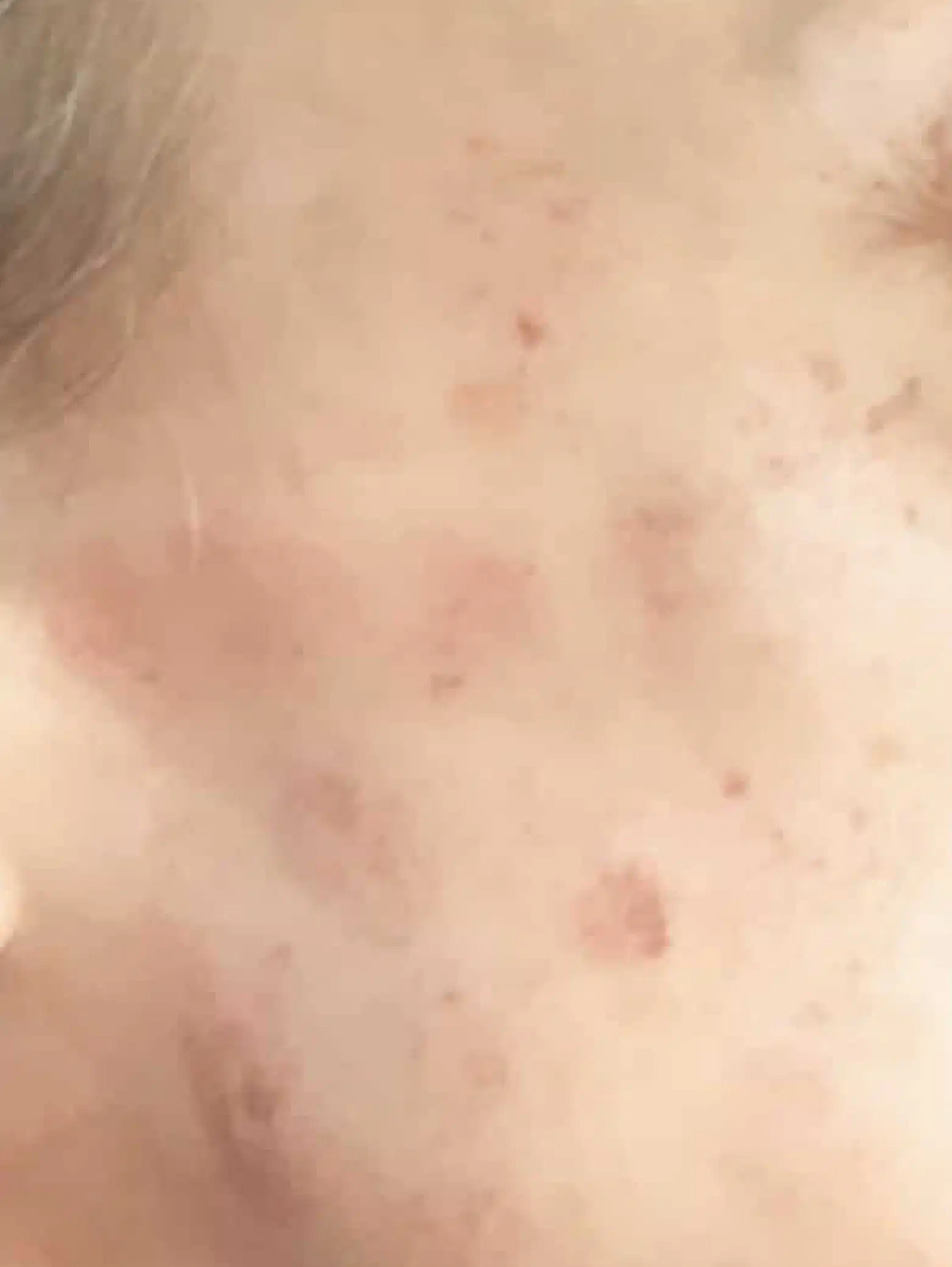 Sun Damage & Redness