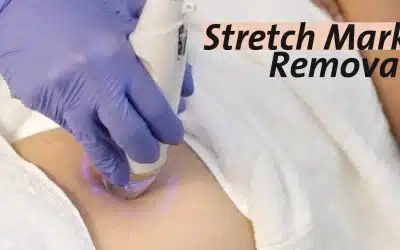 Laser Stretch Mark Removal Near Me