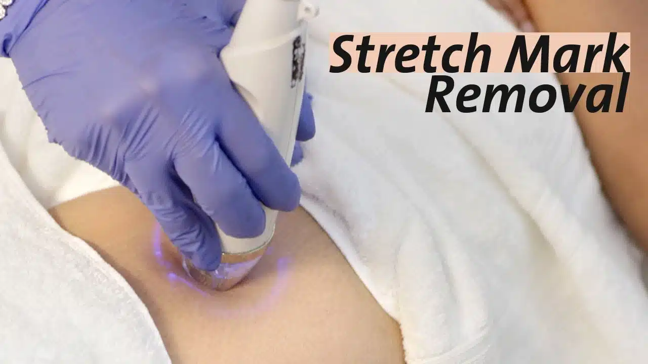 Laser Stretch Mark Removal Near Me Laser Stretch Mark Removal Near Me