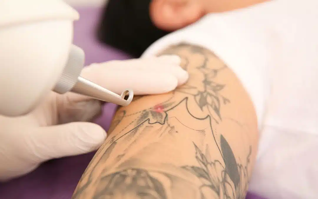 Orlando Laser Tattoo Removal