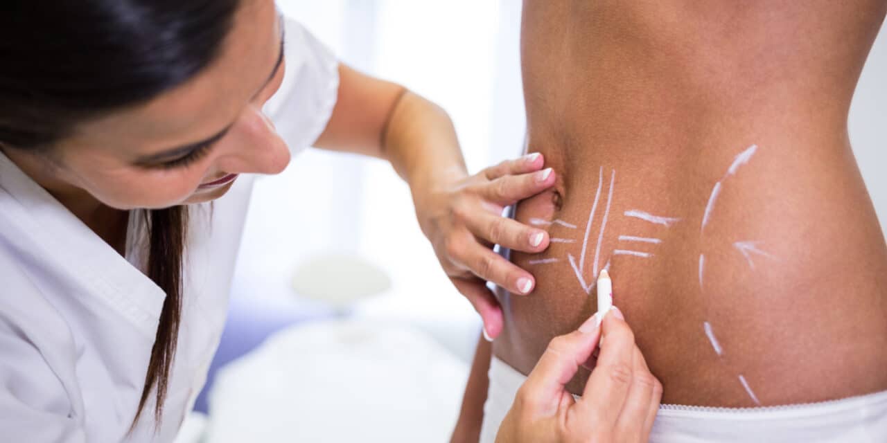 Laser Stretch Mark Removal Near Me