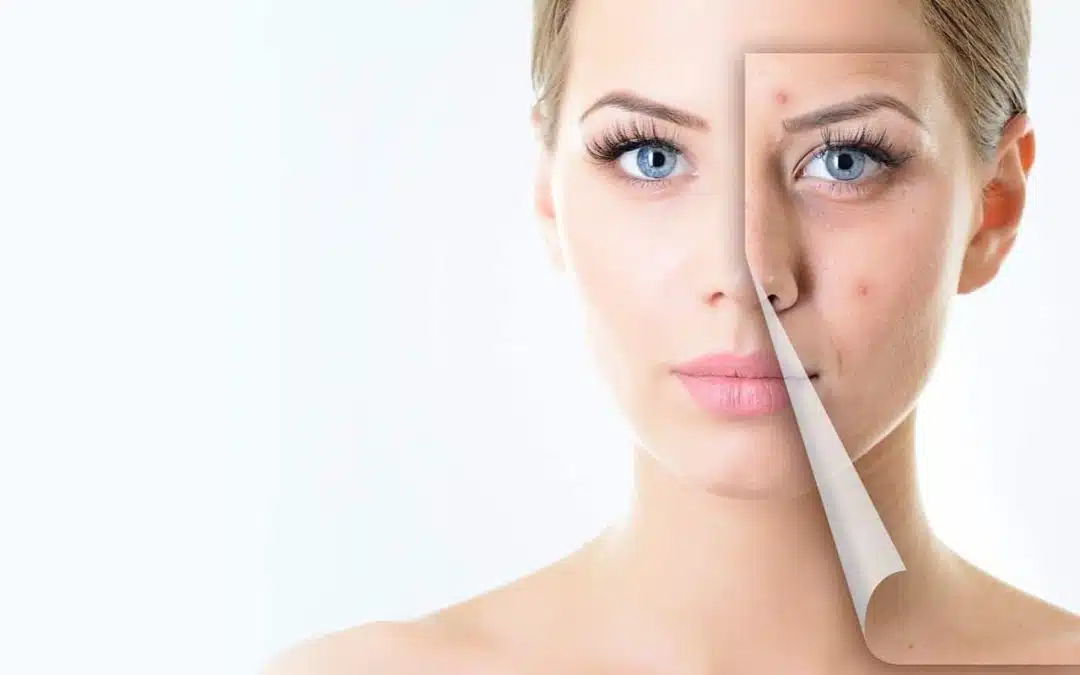 Effective Laser Acne Treatments in Florida | Wymore Laser