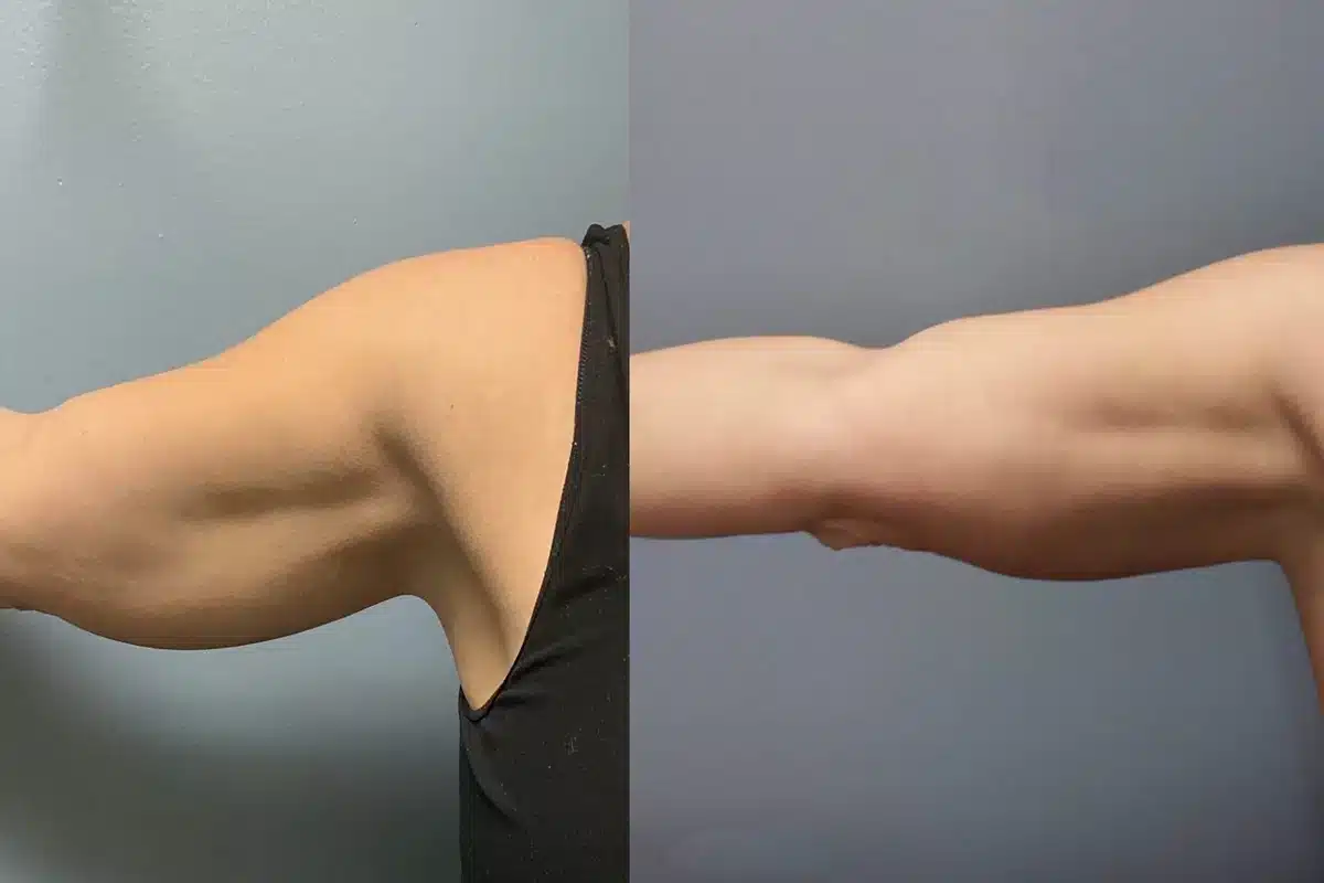 EVOLVE TRIM REMODELS SKIN EVOLVE TRIM REMODELS SKIN