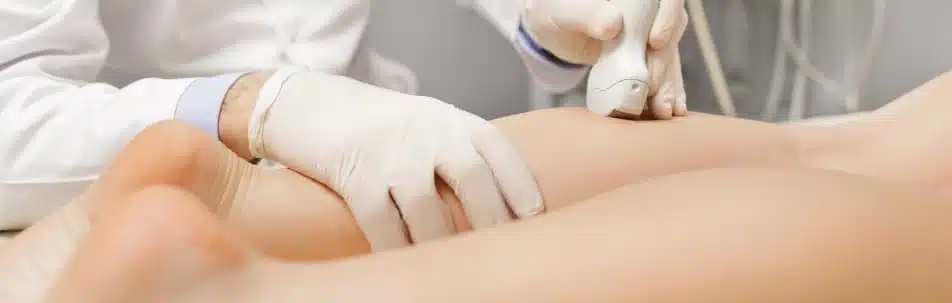 Spider Vein Removal Orlando – Wymore Laser