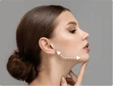 Masseter Reduction