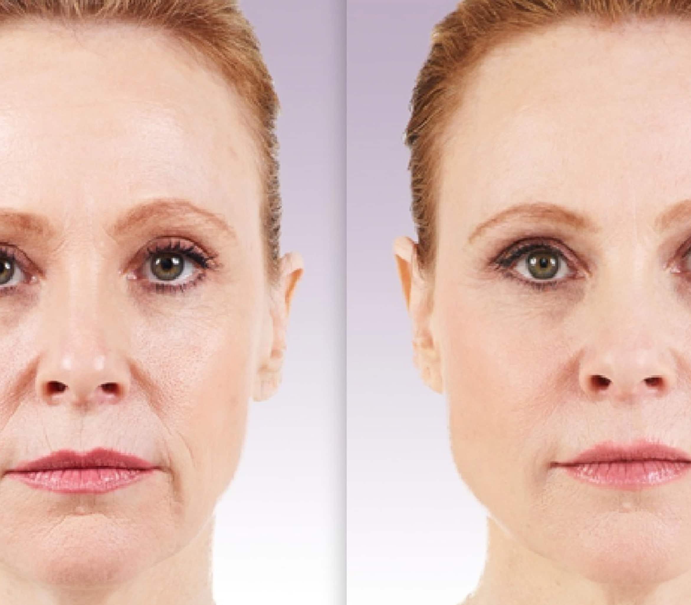 Juvederm-B-A-2 Enhance lips