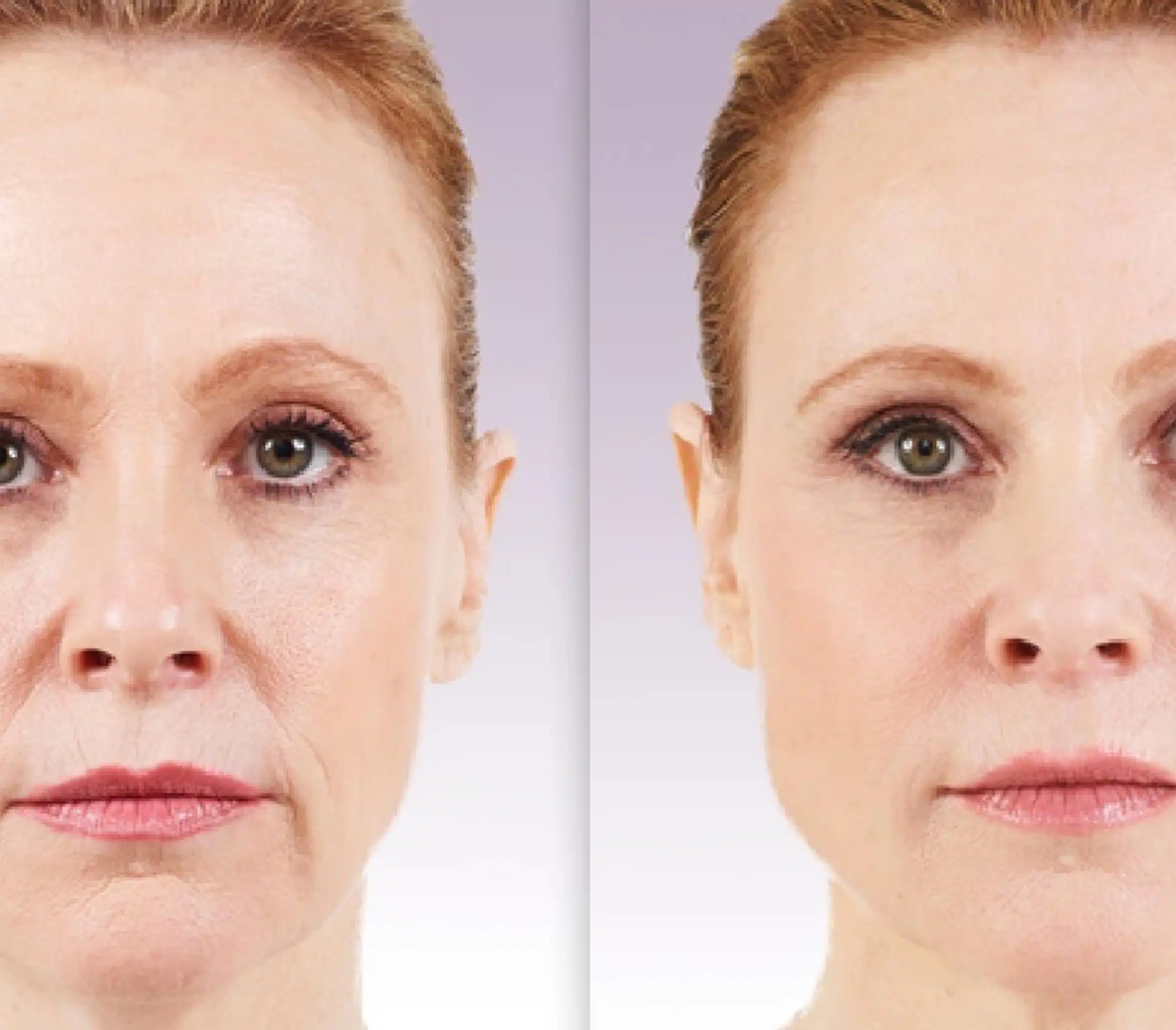 Juvederm-B-A-2 Enhance lips