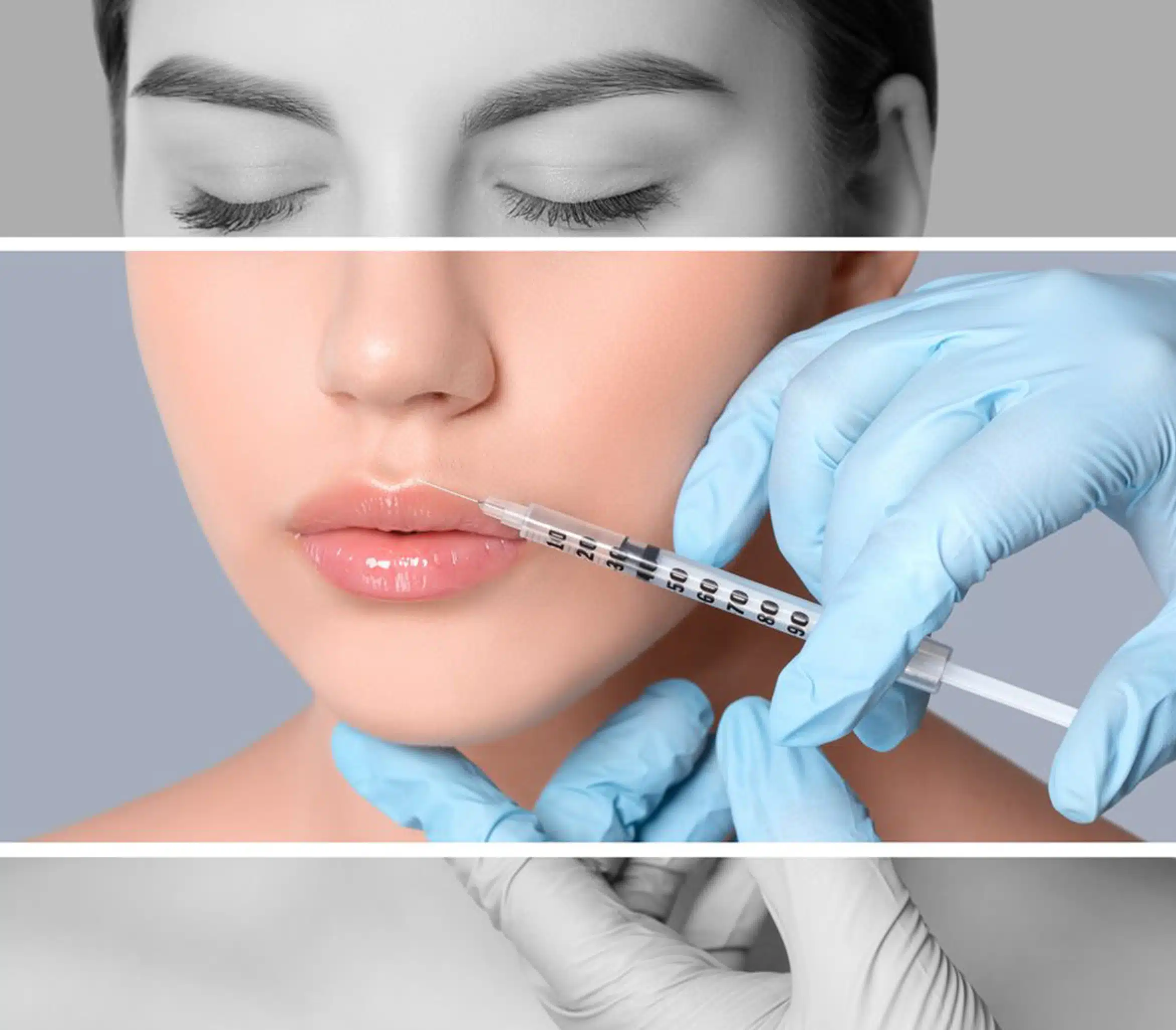 Fillers at Wymore Laser