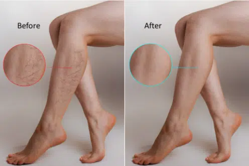 Laser Vein Removal Florida
